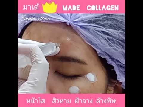 ฉีดมาเด้คอลลาเจน