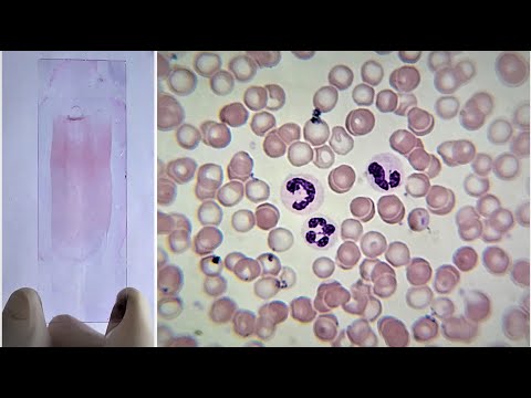 image-What is an eosinophil smear?