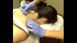 Trigger Point Dry Needling Treatment for Neck Pain Caused by Dystonia