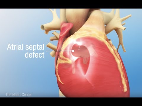 Understanding Atrioventricular (AV) Septal Defect