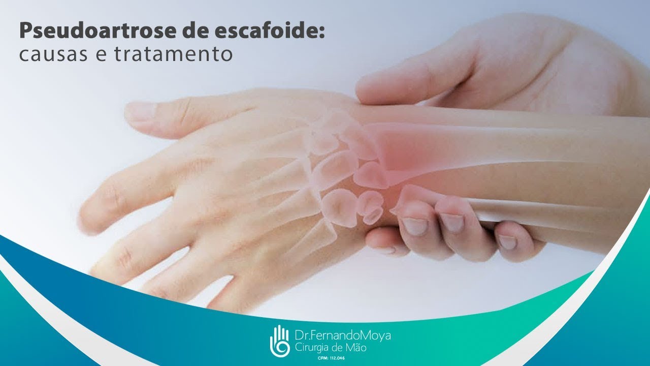 Pseudoartrose de escafoide: causas e tratamento | Dr. Fernando Moya CRM 112046