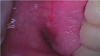 Tooth &amp; Gum Abscesses : Relieving the Pain of an Abscessed Tooth