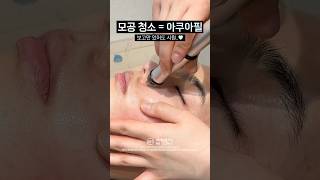 화장품으론 못하는 모공 딥 클린 시술🫧