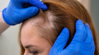 Alopecia  Home Treatment Unveiled