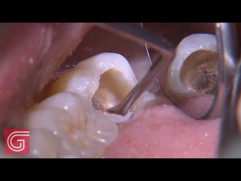 Leczenie ubytku próchnicowego na powierzchni żującej zęba 47 - część 1