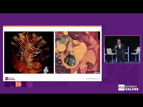 Mastering complex TAVI: overcoming key challenges and achieving optimal outcomes with Evolut FX+