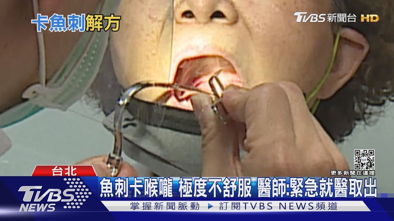 被魚刺卡到喉嚨千萬別做「這件事」　醫師：運氣差恐刺破動脈血管