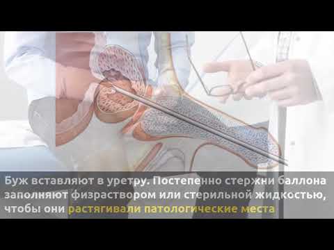 Бужирование уретры
