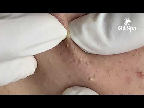 FULL BLACKHEAD