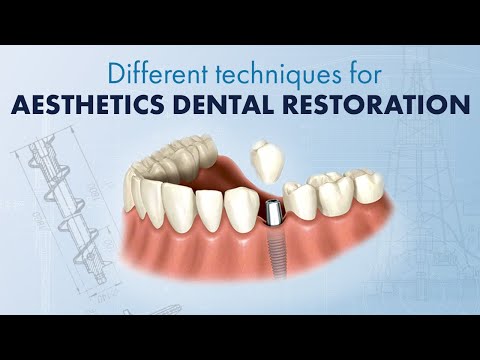 Different techniques for aesthetics dental restoration for front teeth. Composite dental material