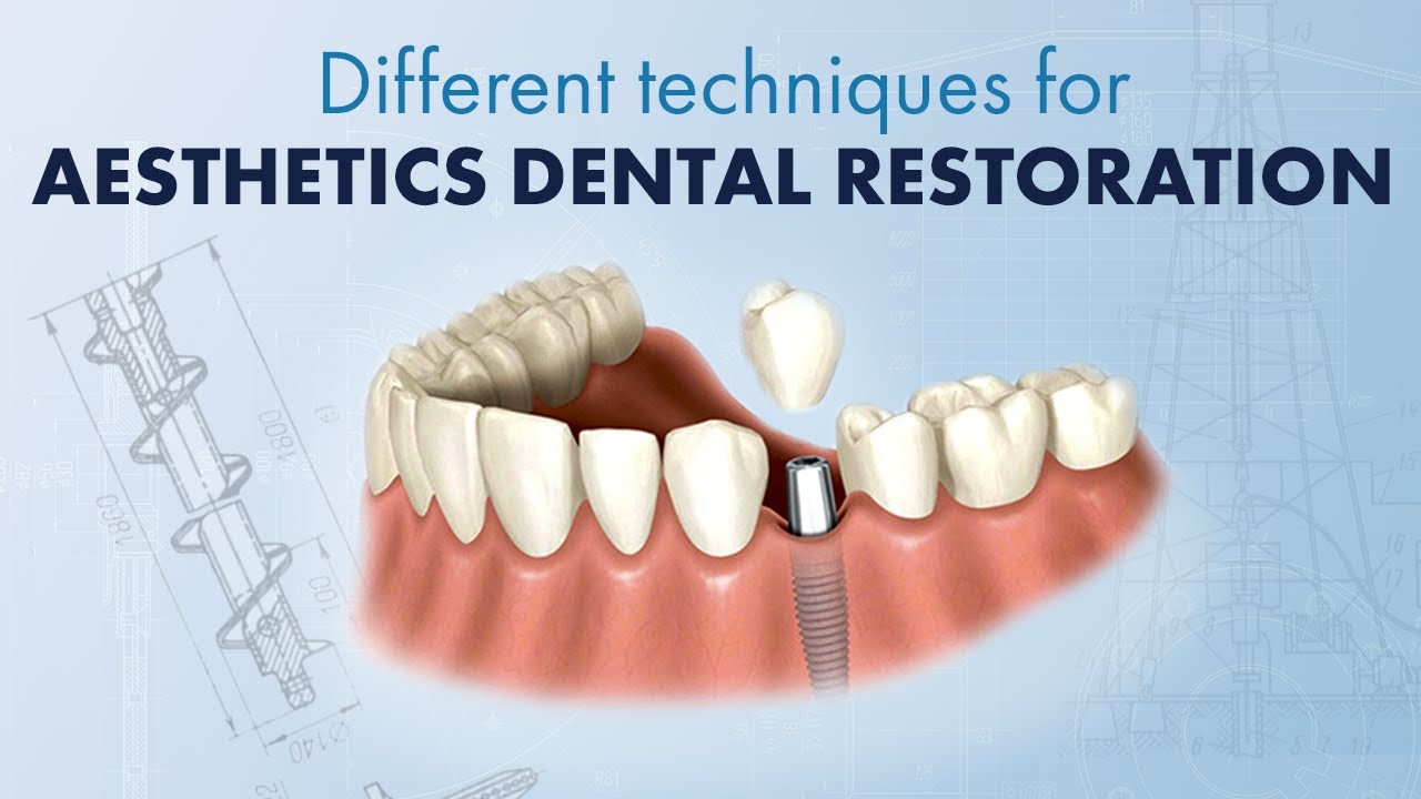 Different techniques for aesthetics dental restoration for front teeth. Composite dental material