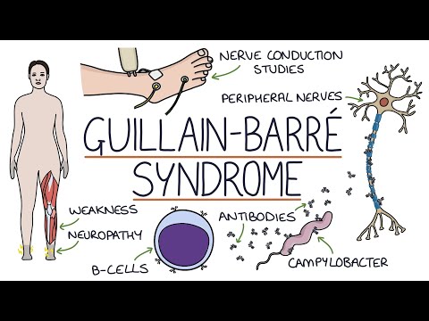 Understanding Guillain-Barré Syndrome