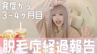 重症型円形脱毛症3〜4ヶ月目の経過報告会 💇🏻‍♀️vol.3【全頭型】