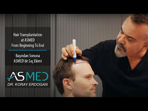 Hair Transplantation at ASMED From Beginning to End