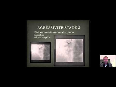 Quand et comment utiliser des techniques plus agressives ?