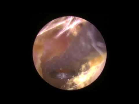 Dry crust of wax removed with Jobson-Horne probe