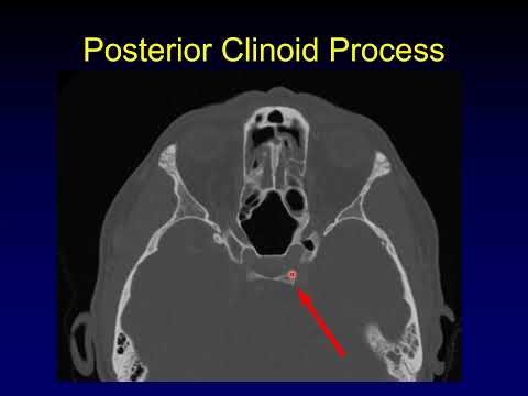 Skull Base Anatomy, Part 1