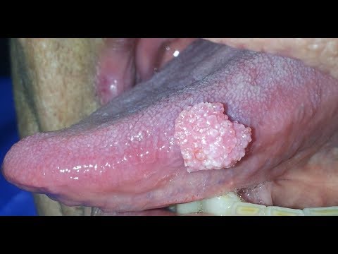 Papilloma virus uomo sintomi gola
