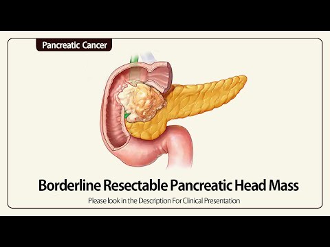 Linear EUS: Borderline Resectable Pancreatic Head Cancer