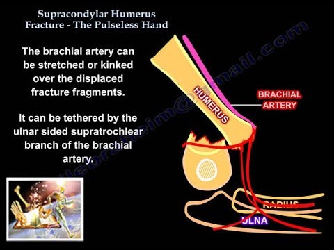 Supracondylar humerus fracture ,  pulseless hand  - Everything You Need To Know - Dr. Nabil Ebraheim