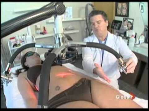 Zerona Laser Treatment | Liposuction | SpaMedicaTV
Video Thumbnail