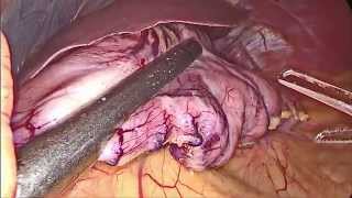 Chirurgia laparoscopica dell'obesità