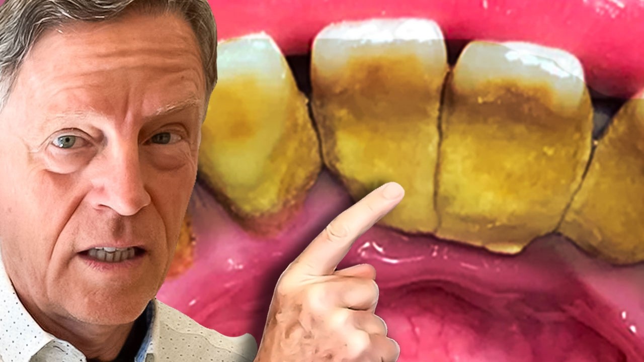 #1 Best Way to Remove Plaque (Tartar) AT HOME