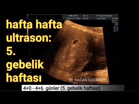 5. gebelik haftasında anne karnındaki bebek - Gebelik kesesi ve organlar oluşmaya başladı