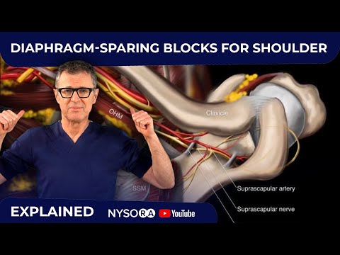 Diaphragm-Sparing Blocks for Shoulder Analgesia