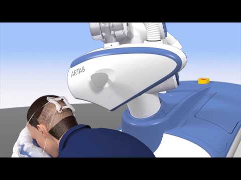 ARTAS Hair Transplant Procedure