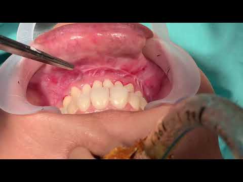 Redo Chin Surgery
