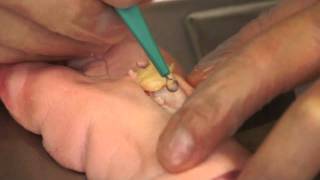 Understand Wound Care: Sharp Debridement Demo of Wound with Yellow Necrosis