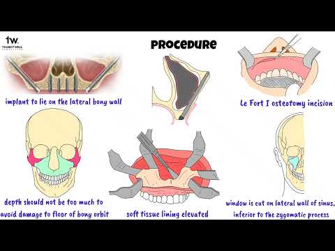 Unlocking the Power of Zygomatic Implants: Essential Knowledge for Dental Students