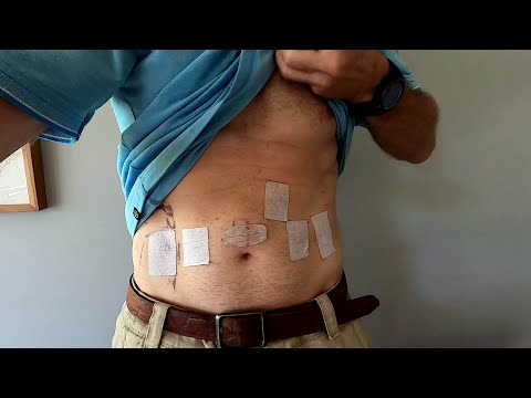 My Prostate Cancer Journey - Episode 4 - an Aussie perspective - 2 Weeks Post Surgery