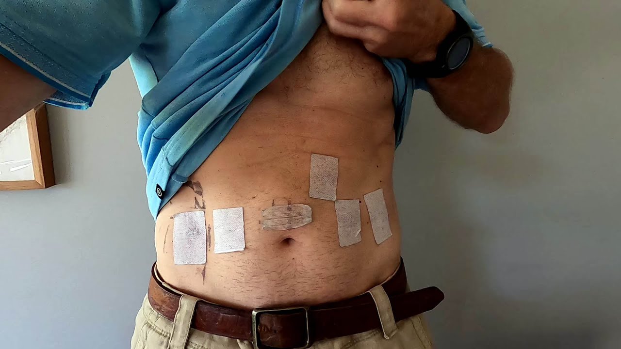 My Prostate Cancer Journey - Episode 4 - an Aussie perspective - 2 Weeks Post Surgery