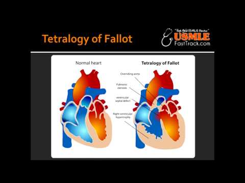 Tetralogy of Fallot