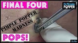Our FOUR FINAL POPS for you - PIMPLE POPPER MADNESS!!