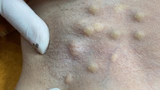 TREATMENT OF TERRIBLE ACNE IN THE NECK
