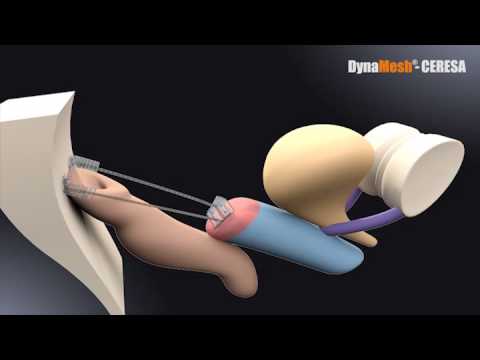 Dynamesh CERESA animace