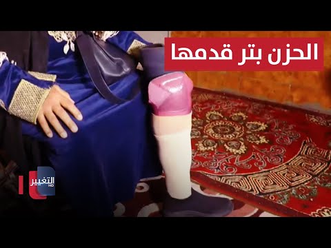 شاهد بالفيديو.. الحزن بتر قدمها.. عراقية تستنجد برئيس الوزراء لإنصافها | نريد وطن