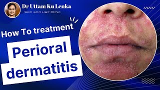 Perioral dermatitis(Acne & Rosacea)| Red rashes around mouth/ face me rashes ka karan? #druttam