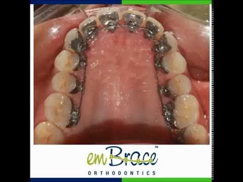 Invisible/Hidden Braces (Embrace Orthodontics)