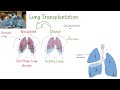 Lung Transplant Surgery, Survival, Organ Rejection. Risk-Benefit