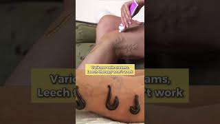 Can varicose vein creams treat varicose veins effectively #varicoseveins #vascularsurgeon #creams