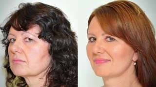 Facelift, necklift, eyelid adjustment - Alena