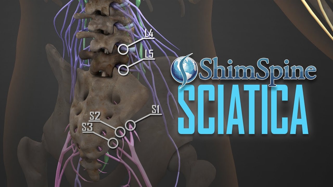 Sciatica