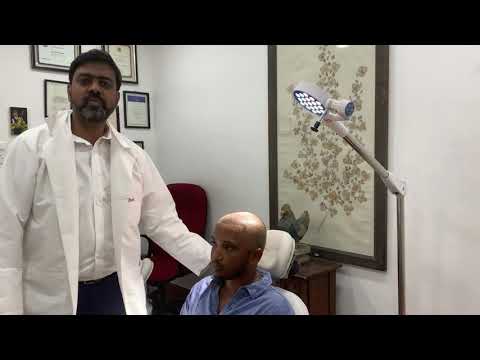 FUE Hair Transplant Surgery