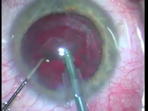 Come prevenire adenoma prostatico Qual è ablazione laser del adenoma prostatico