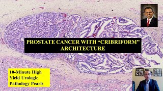 Download Lagu Prostate Cancer with Thumbnail
