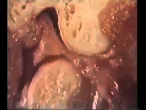 Chirurgia del borsite al ginocchio Per trattare lartrite congiunto piede